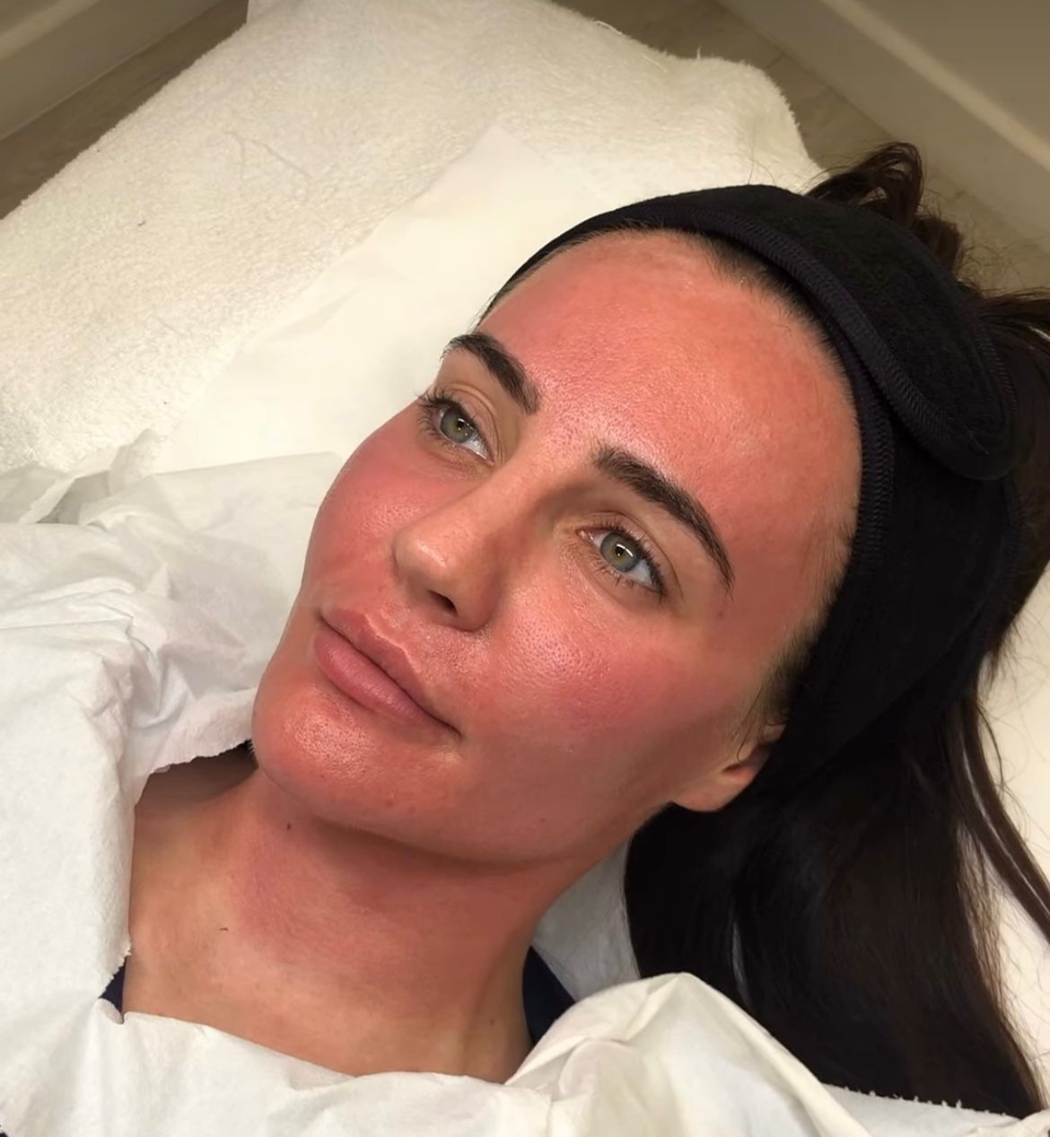 A collagen-inducing treatment that improves skin texture, reduces scars, and minimizes fine lines