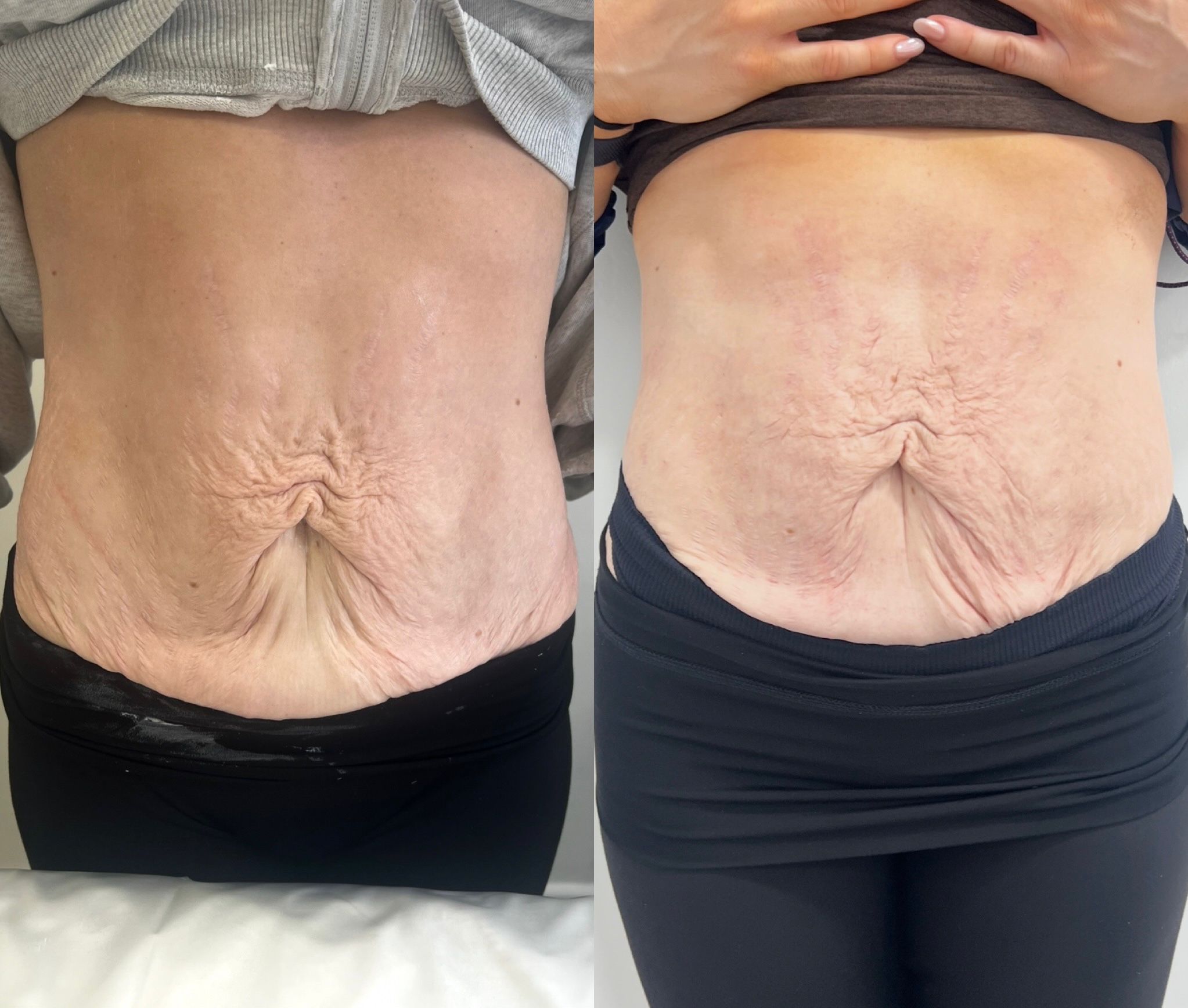 An advanced skin-tightening treatment that combines microneedling with radio frequency energy to firm and lift.